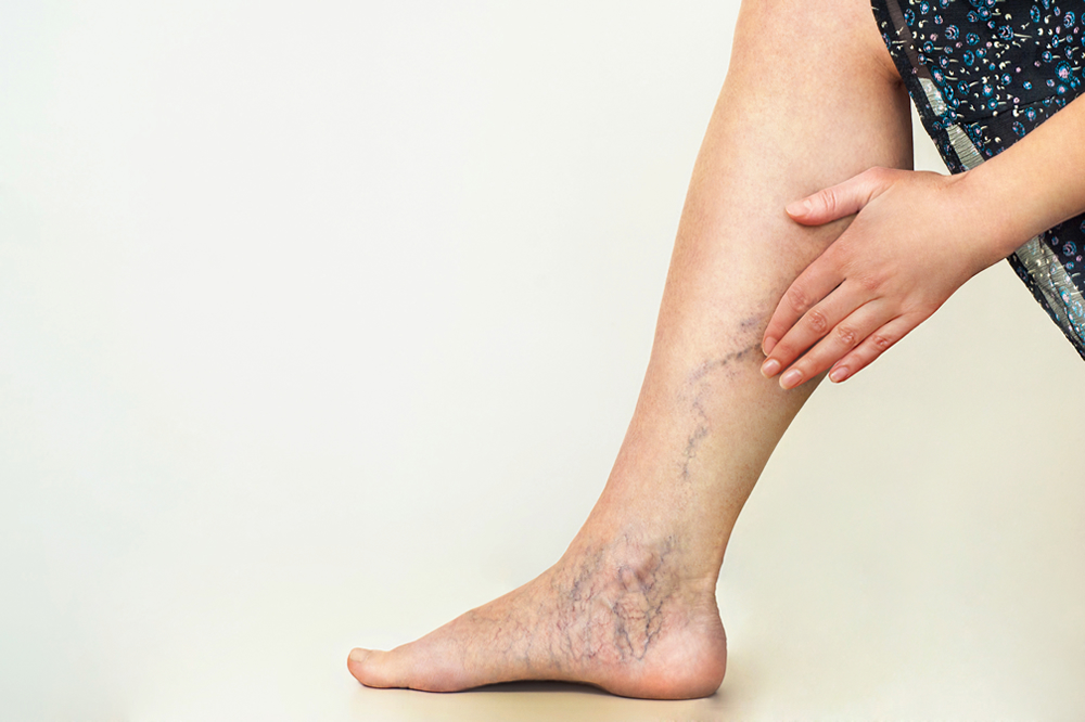 Varicose veins